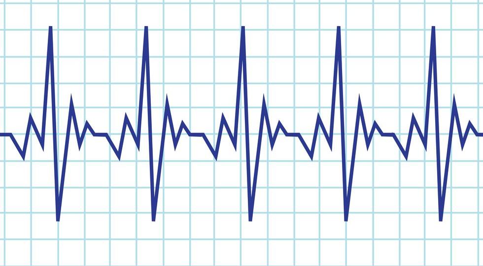 EKG